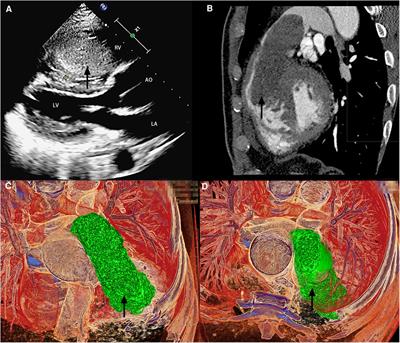 Case report: Resection of a giant right ventricular myxoma